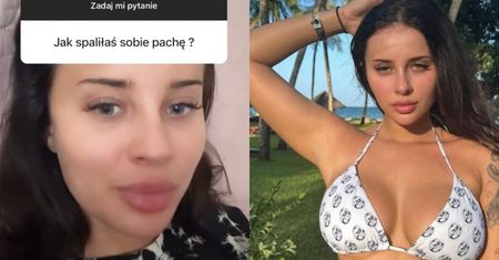 Fagata żali się na oparzenie chemiczne pachy. "Jest SPALONA". Chcieliście to wiedzieć?