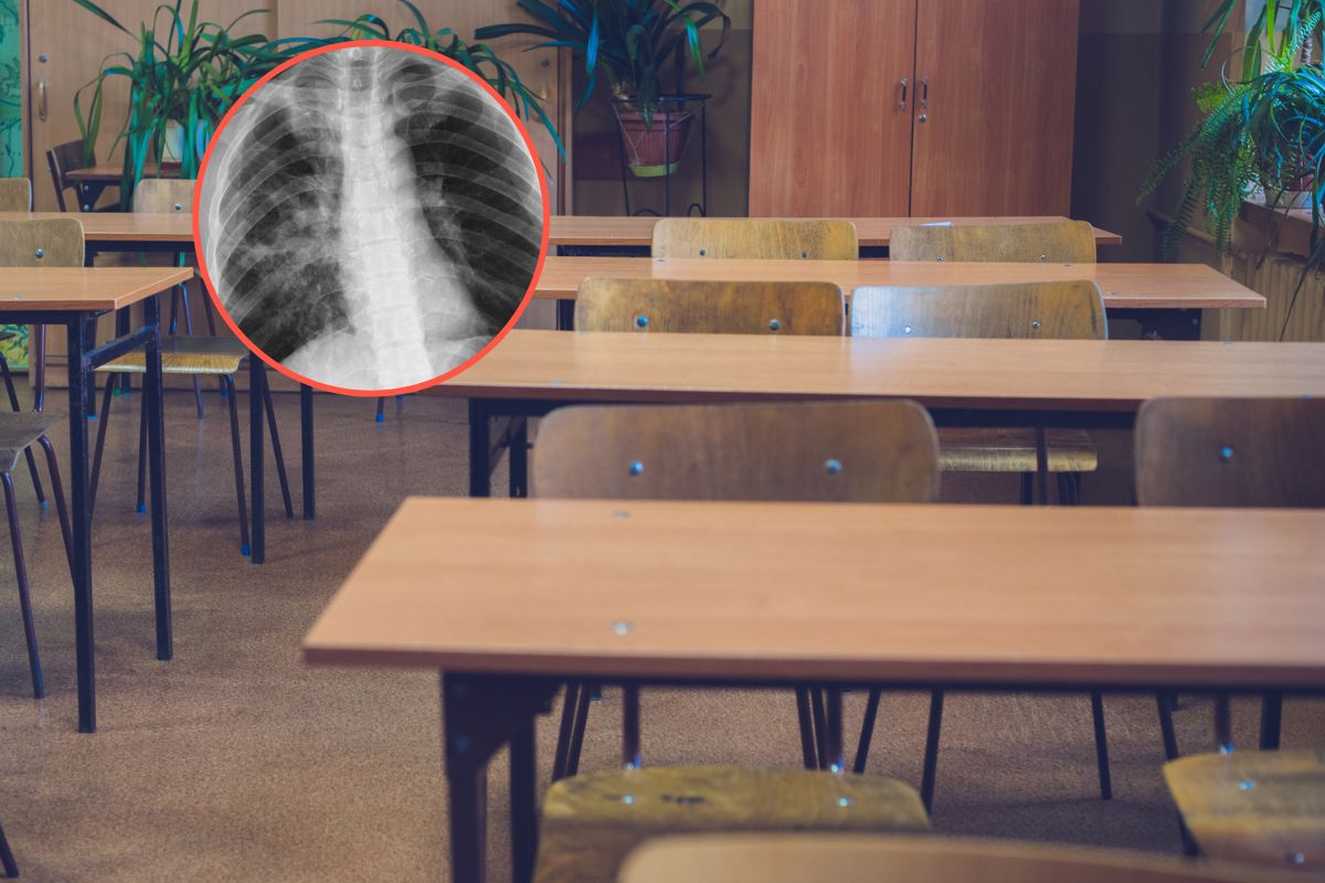 Gruźlica w krakowskim liceum. Uczeń trafił do szpitala, trwa dochodzenie