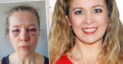Anna Powierza wycięła nadmiar skóry z twarzy. Opowiedziała o zabiegu i pokazała odważne zdjęcia