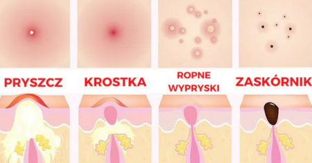 Oczyszczanie cery w domowych warunkach. Pożegnaj się z rozszerzonymi porami