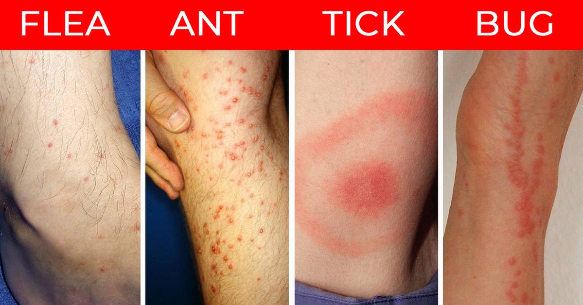 How to Recognize 7 Kinds of Common Insect Bites