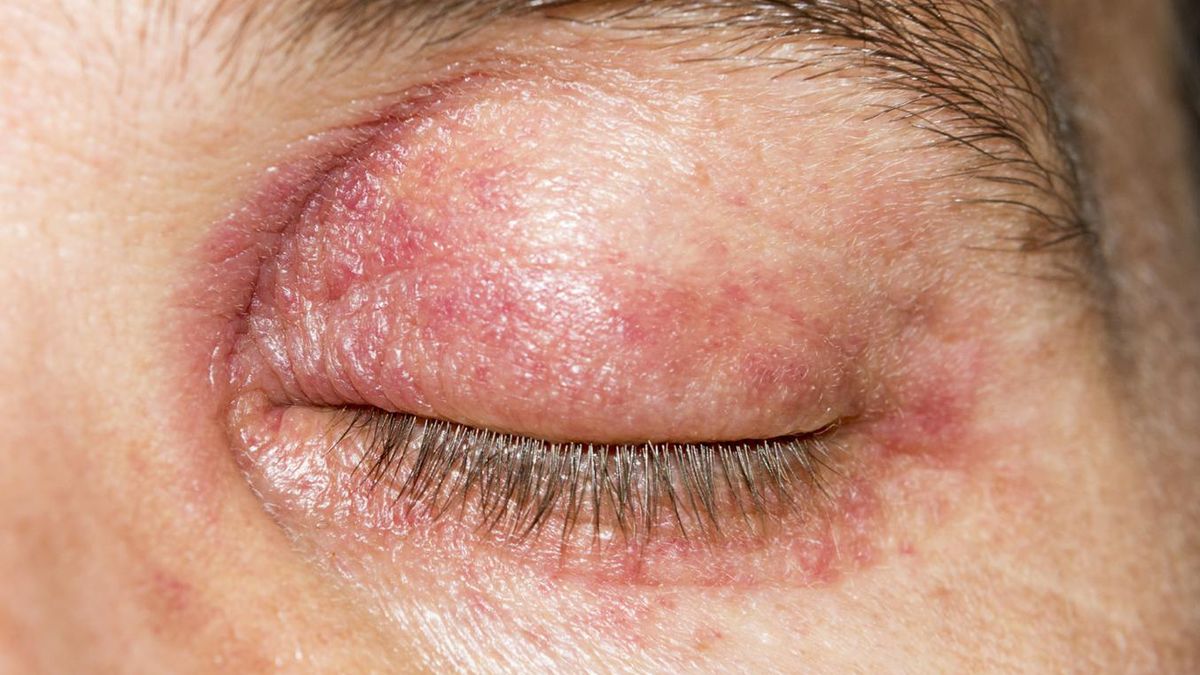 "Rumień na powiekach to nie są tylko czerwone powiek". Lekarka ostrzega