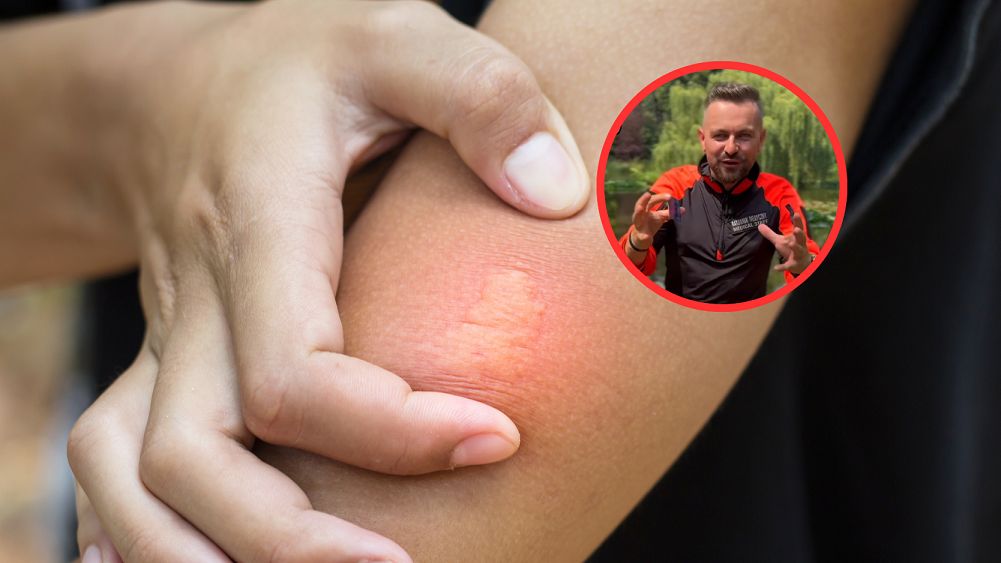 Trik, który może uratować ci życie. Ratownik pokazuje sposób na użądlenie pszczoły