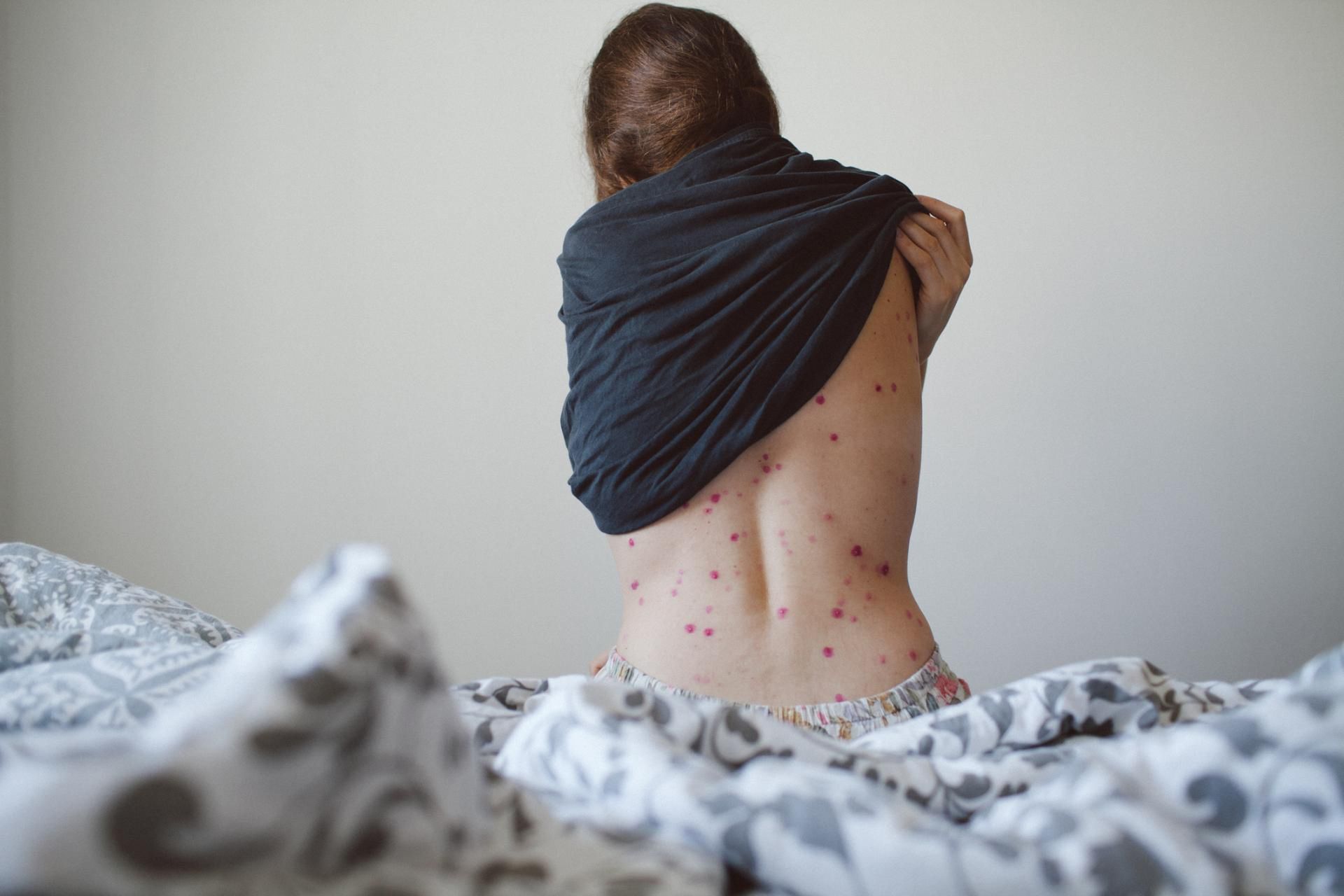 U dorosłych ospa może prowadzić do poważnych powikłań