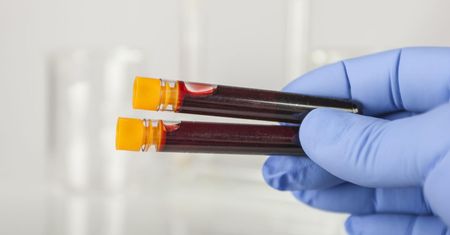 Biochemia krwi –  profile oznaczeń, normy