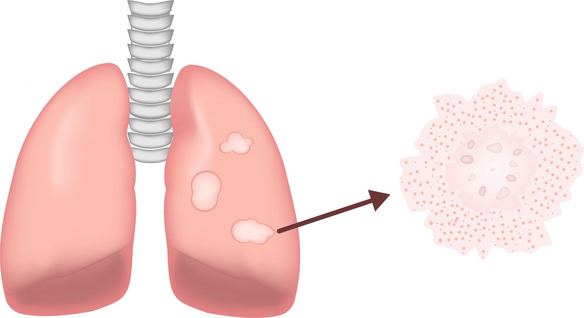 Sarkoidoza polega na gromadzeniu się grudek zapalnych najczęściej w płucach