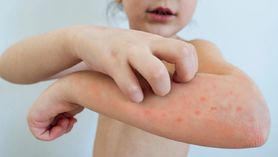 Wysypka u dziecka - alergia czy choroba zakaźna?