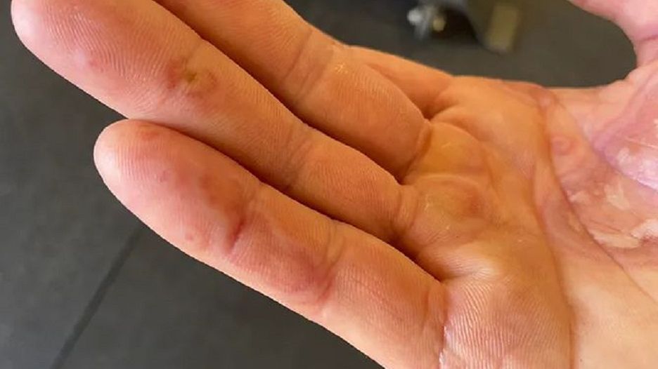 Covidowe palce. Jak wyglądają?