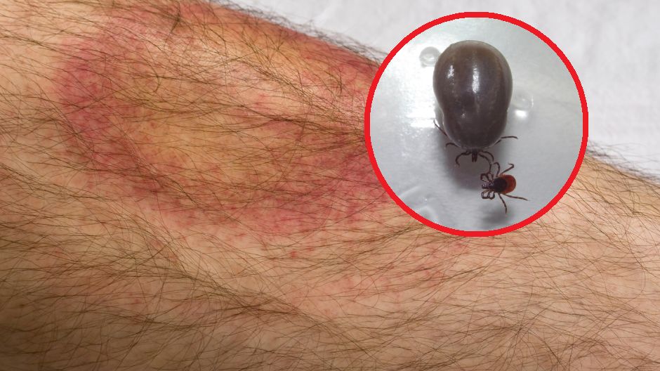 Stosowanie tej niepotwierdzonej badaniami metody leczenia boreliozy może mieć bardzo poważne skutki uboczne