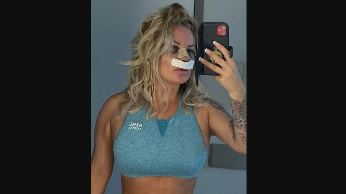 Poleciała do Turcji na operację nosa. Po nieudanym zabiegu wróciła z dziurą pod uchem