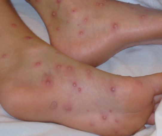 Wysypka może pojawić się również na dłoniach i stopach osób zakażonych
