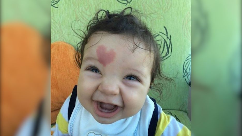 Chłopiec ma na czole znamię w kształcie serca