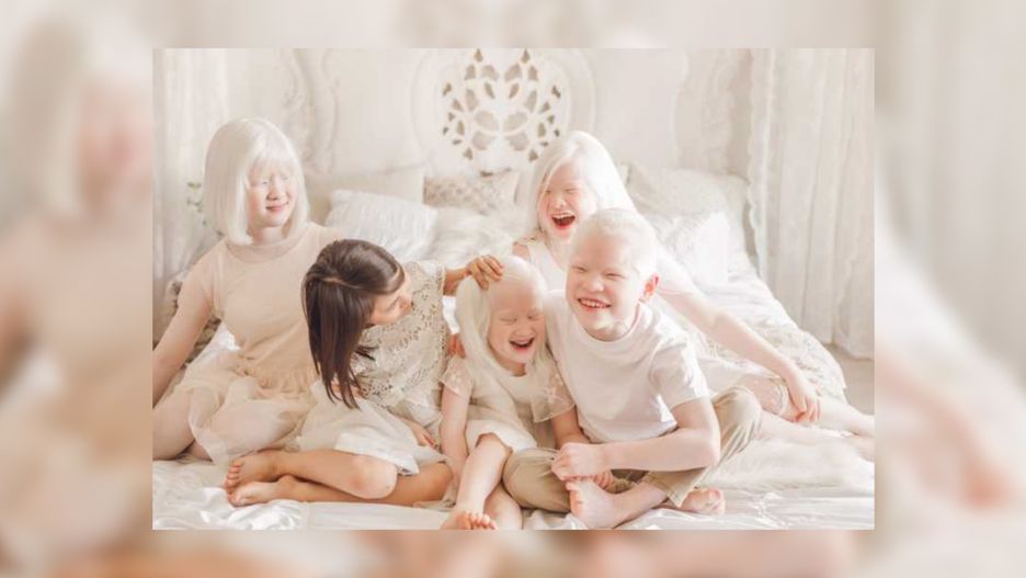 Adoptowali 4 dzieci z albinizmem