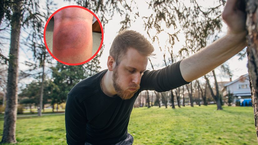 Widoczny objaw boreliozy. "Pojawia się w miejscu wkłucia"