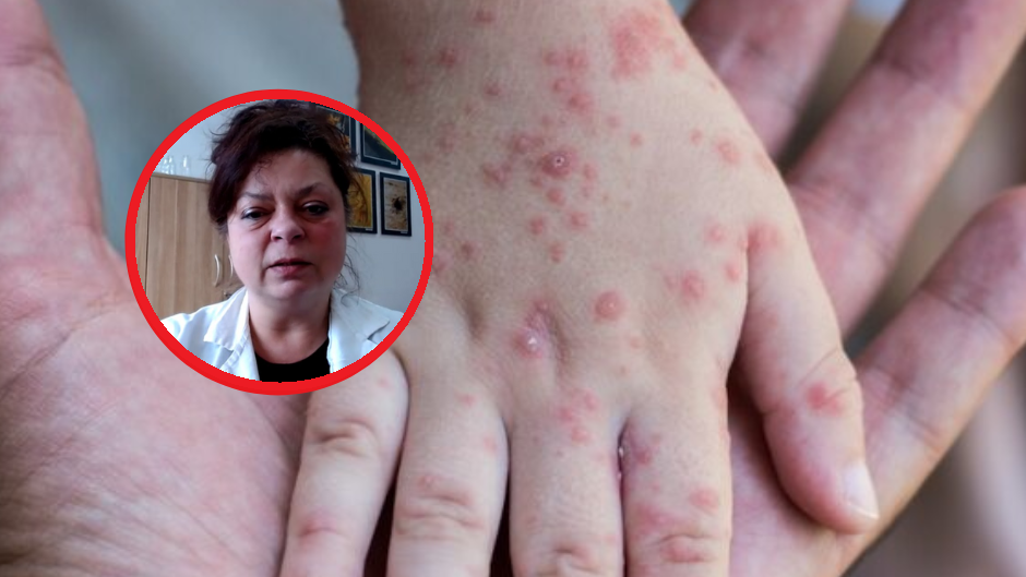 Zapomniana choroba atakuje w Polsce. Wirusolog przestrzega: będą epidemie wyrównawcze