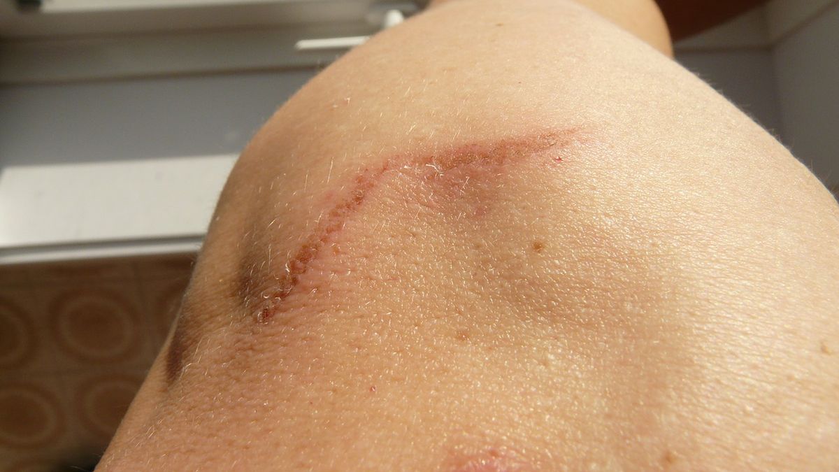 Cena maści na blizny może wynieść od 25 do nawet 200 zł