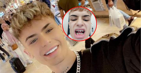 Model zrobił sobie tureckie zęby. Przez infekcję wyglądał jak rekin. "To był horror"