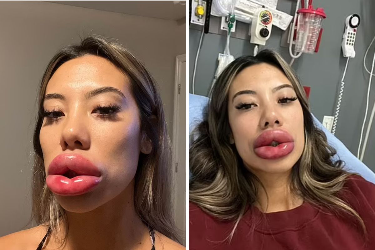 Reakcja anafilaktyczna sprawiła, że jej usta spuchły