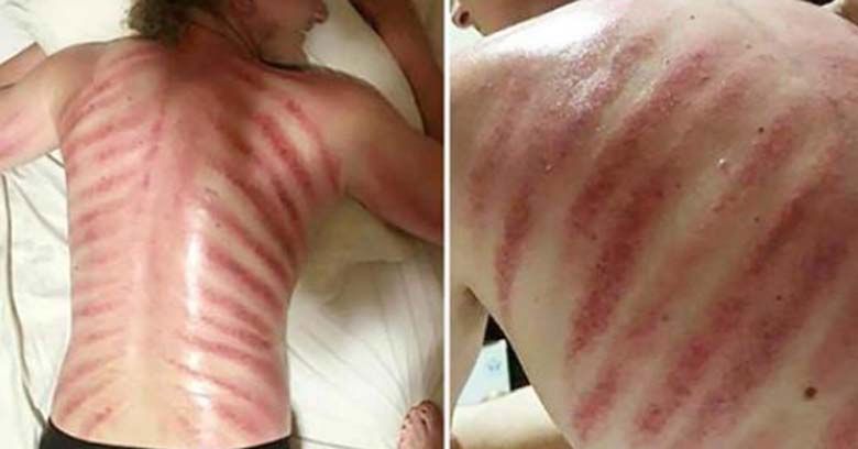 Plecy mężczyzny pokrywały czerwone pręgi