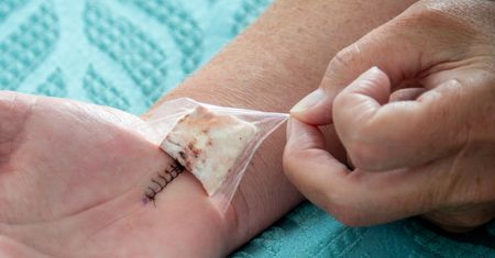 Operacja cieśni nadgarstka – wskazania, przebieg, możliwe powikłania