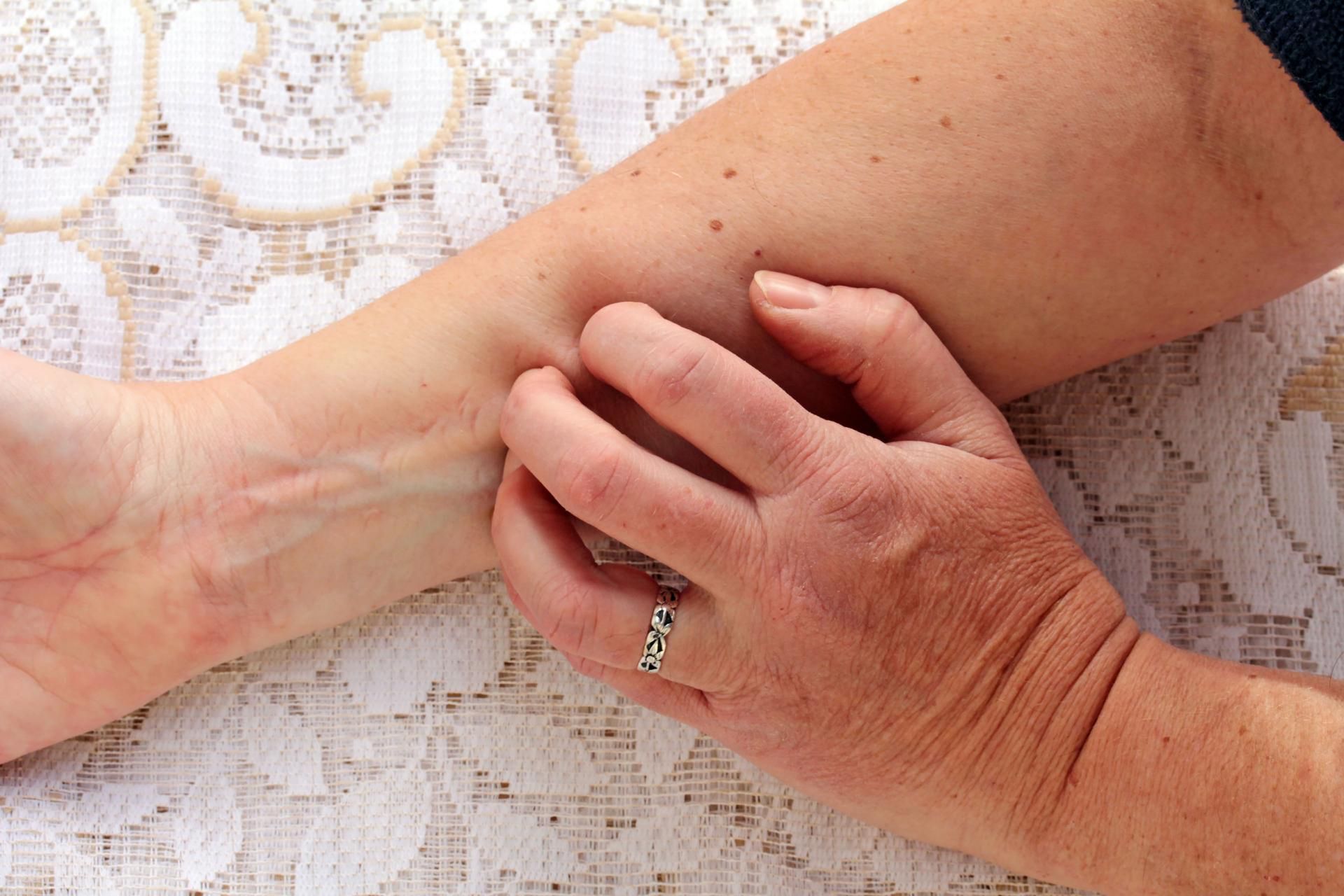 Atopowe zapalenie skóry to choroba bardzo uciążliwa