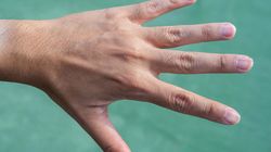 Nie lekceważ tych zmian na paznokciach. Mogą być objawem chorej wątroby