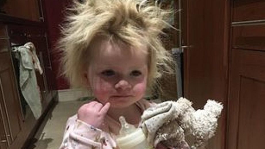 Jej włosów nie da się uczesać. Dziewczynka urodziła się z rzadkim schorzeniem