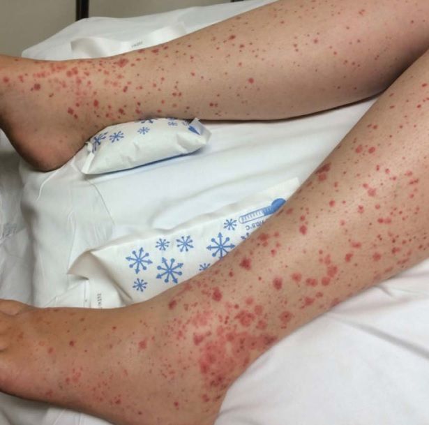 Zmiany skórne przy COVID-19