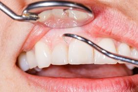 Choroby wywoływane przez próchnicę. Nie jest to tylko problem zębów