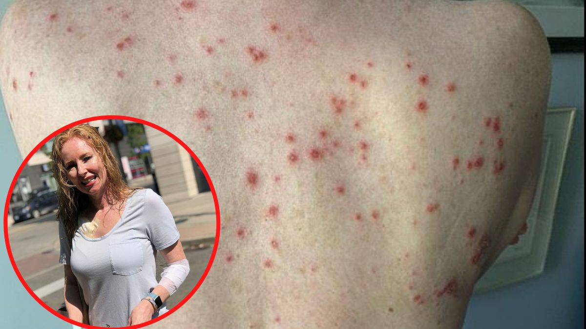 Musi codziennie nakładać krem chemioterapeutyczny