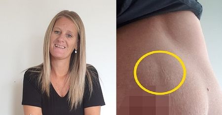 Kobieta myślała, że ma rozstępy. Okazało się, że to rak