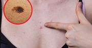 To zwiastun groźnego raka. Charakterystyczny objaw widać na skórze