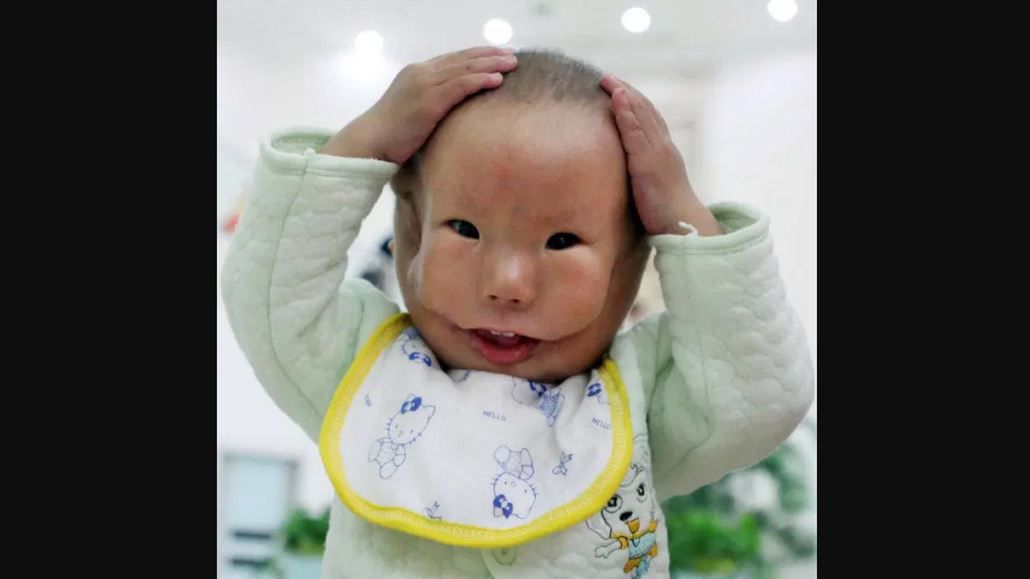 Urodził się z rzadką deformacją twarzy. Nazwali go "Mask Boy"