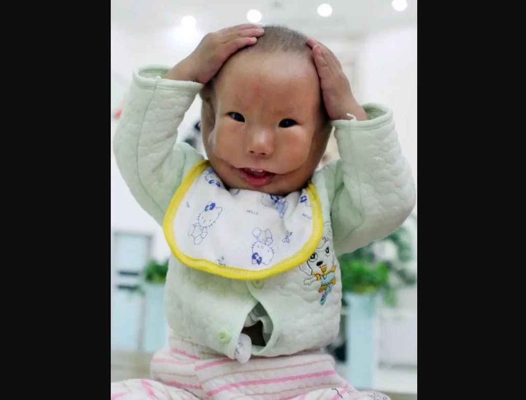 Urodził się z rzadką deformacją twarzy. Nazwali go "Mask Boy"