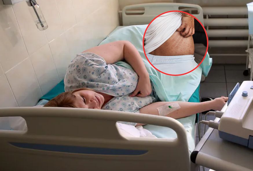 Zachoruje co trzecia osoba po ospie. Wirus może uaktywnić się po latach