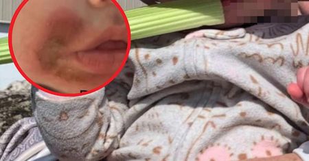 Matka myślała, ze pomoże na ząbkowanie. W ciągu dnia pojawiły się pęcherze