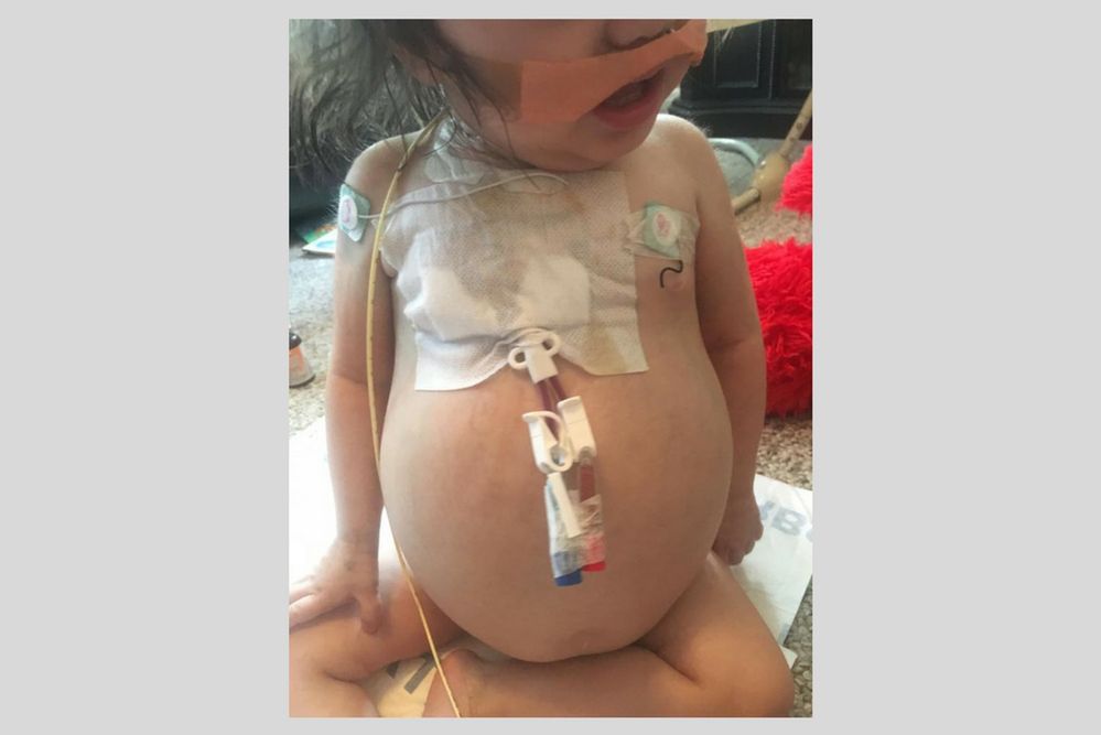 Dziewczynka wygląda, jakby była w ciąży. To objaw choroby genetycznej