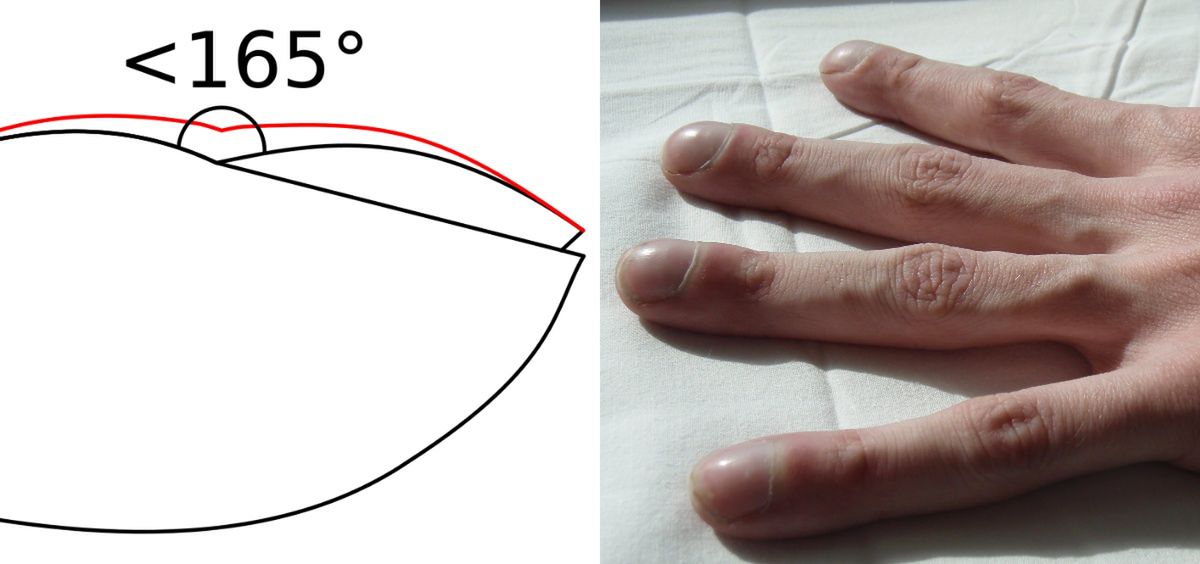 Palce pałeczkowate charakteryzuje miękkie łożysko paznokcia oraz błyszcząca skóra w ich okolicach