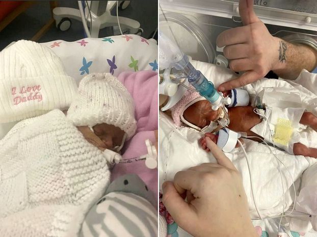 Ava i Ayla urodziły się w 25. tygodniu ciąży