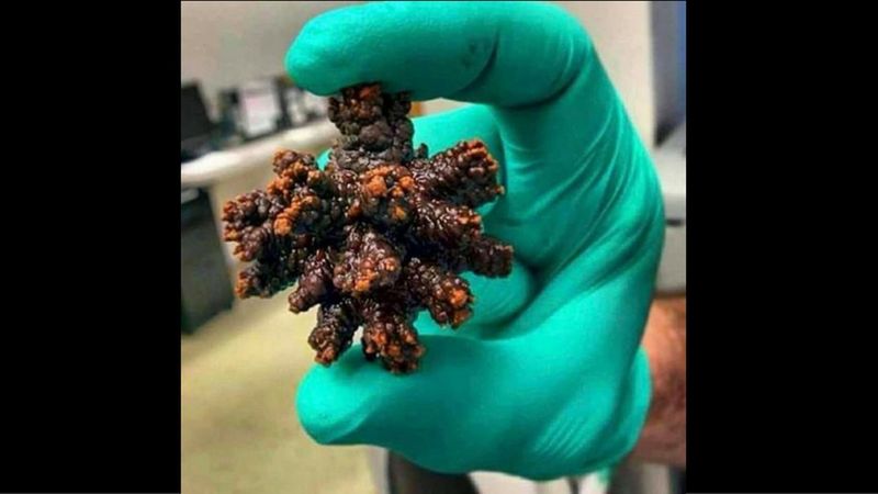 Mężczyzna cierpiał na kamicę nerkową. Rozmiar usuniętego z pęcherza kamienia naprawdę szokuje