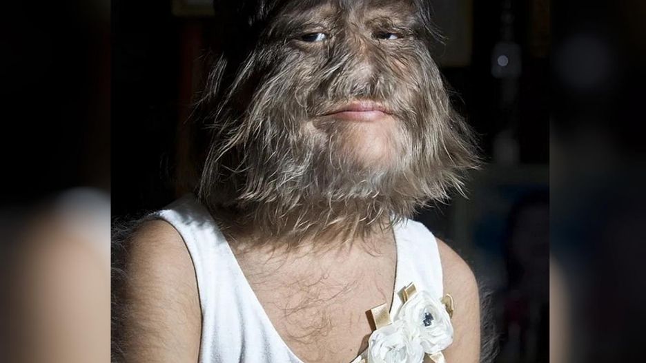 Była nazywana "najbardziej owłosioną dziewczynką na świecie"