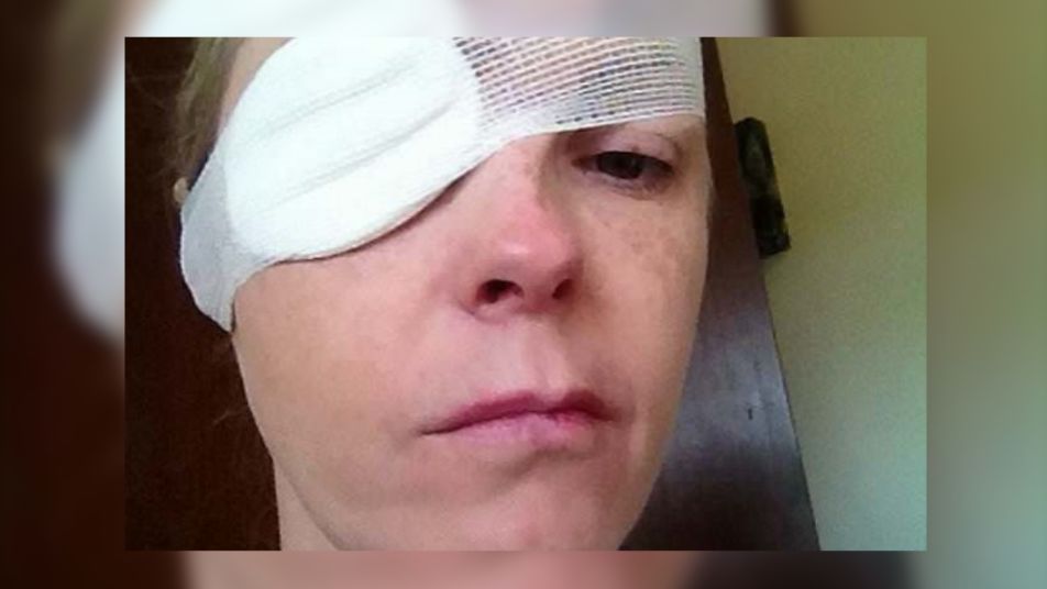 Rachel urgyziona przez kleszcza