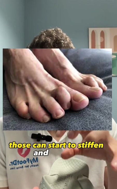 Częste noszenie klapek może spowodować nawet trwałe deformacje palców, jak palce młotkowate lub szponiaste