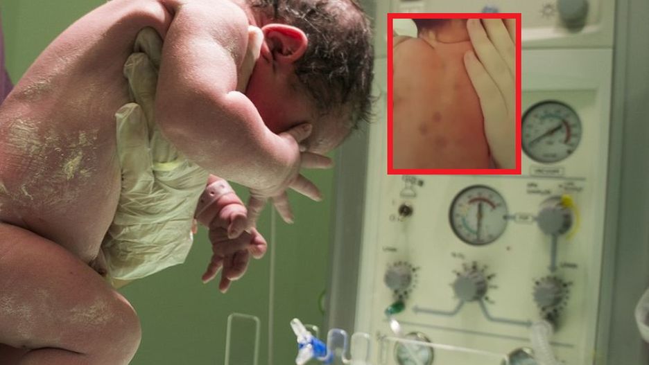 Nic nie zapowiadało dewastującej diagnozy. Jedynym objawem były fioletowe kropki