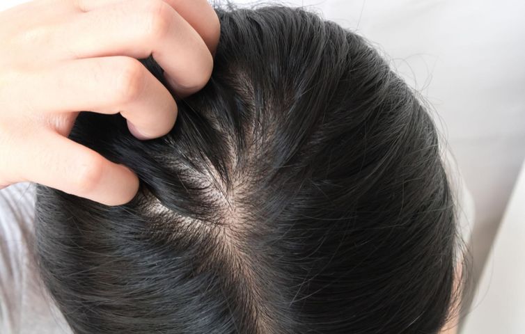 Swędzenie skóry głowy może być objawem niedoczynności tarczycy 