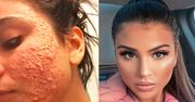 Trądzik zniszczył jej życie. Gdy się go pozbyła, została modelką