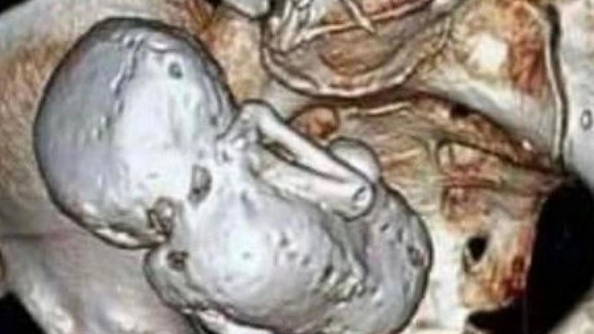Skarżyła się a ból brzucha. W jej ciele znaleziono "kamienny płód"