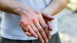 Gwiazdy, które chorują na łuszczycę. Nie wstydzą się swojej choroby