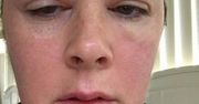 Trwały makijaż wypalił kobiecie brwi. Teraz ostrzega innych