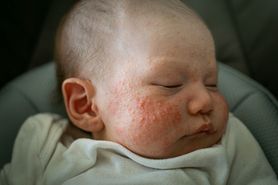 Łojotokowe zapalenie skóry u niemowląt: objawy, leczenie, profilaktyka